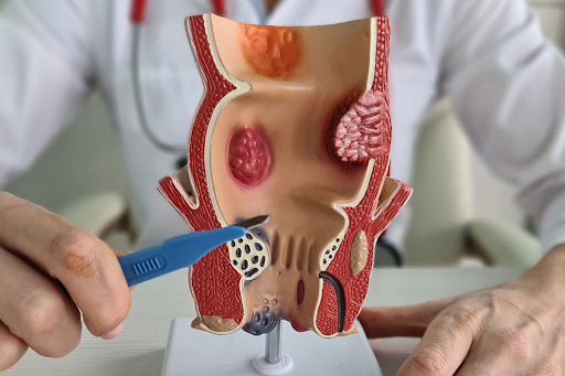 Overcoming Hemorrhoid Pain: How the Hemorrhoidectomy Procedure Can Improve Your Quality of Life